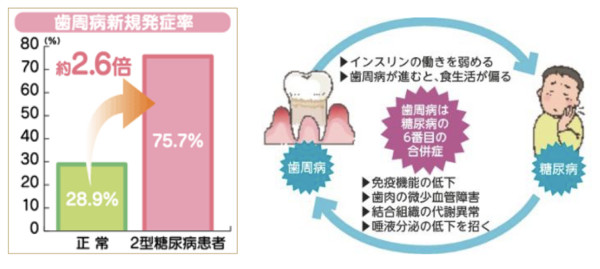 歯周病と糖尿病の関係