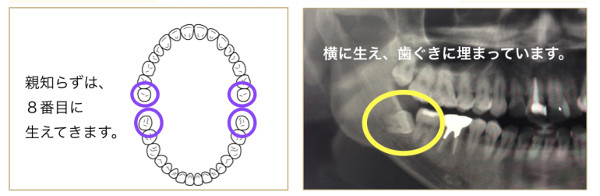 怖くない！？親知らず