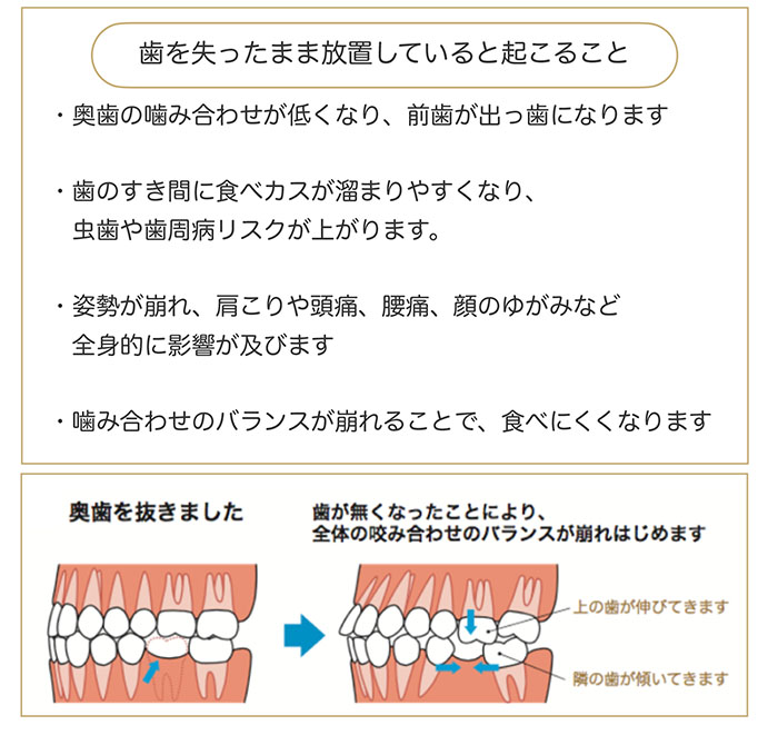 歯を失ったまま放置するリスク