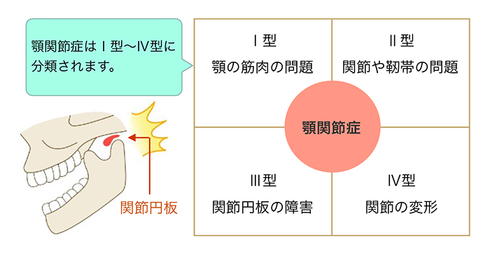 顎（あご）が痛む顎関節症