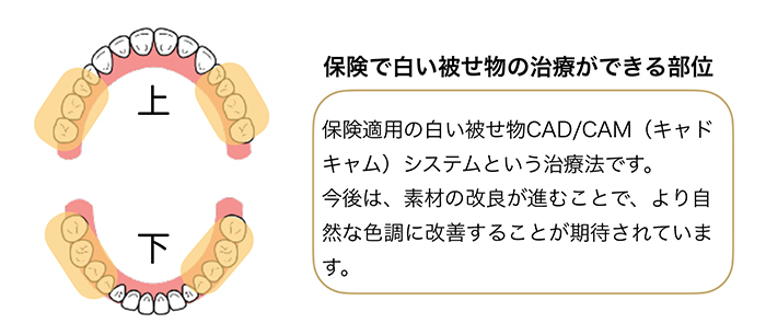 新素材の開発で進む保険治療