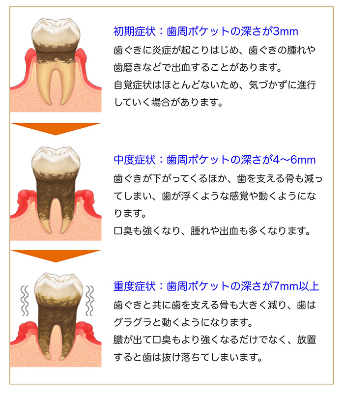 歯周病の進行の流れ