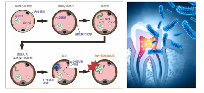 むし歯で認知症リスクが上がる！？