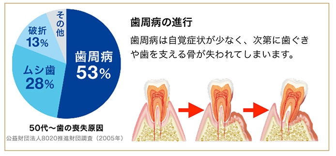 歯を失う原因で最も多い歯周病