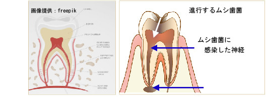 歯の根の治療　原因はムシ歯菌！