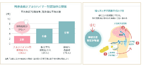 歯周病と認知症の関係