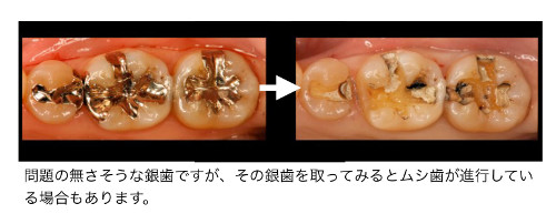 ムシ歯の再発　二次カリエス