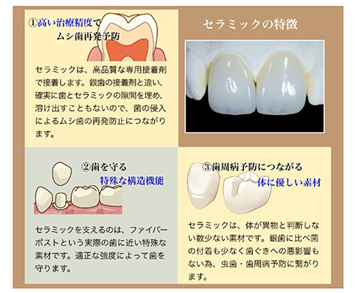 お口の健康を高めるセラミック治療