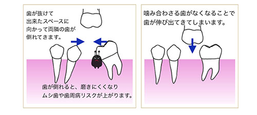 抜けたままの歯　大丈夫？