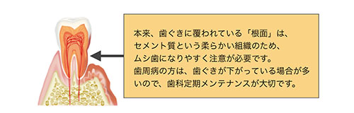 ムシ歯になりやすい根面