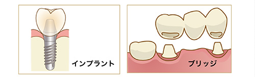 インプラント治療コースセミナー