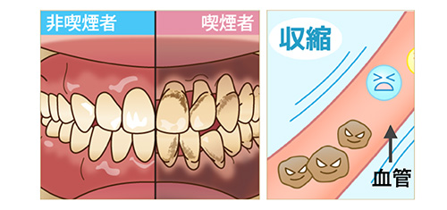 喫煙と歯周病の関係