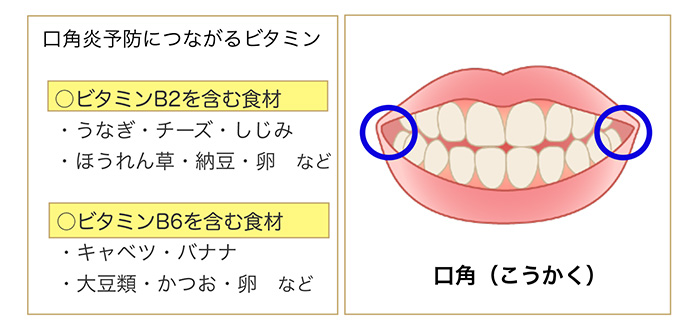 ビタミン摂取で口角炎予防