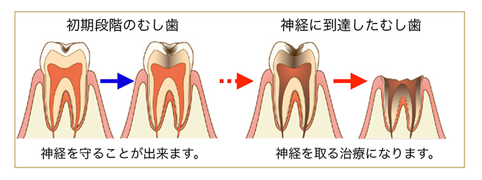 自然には治らない むし歯