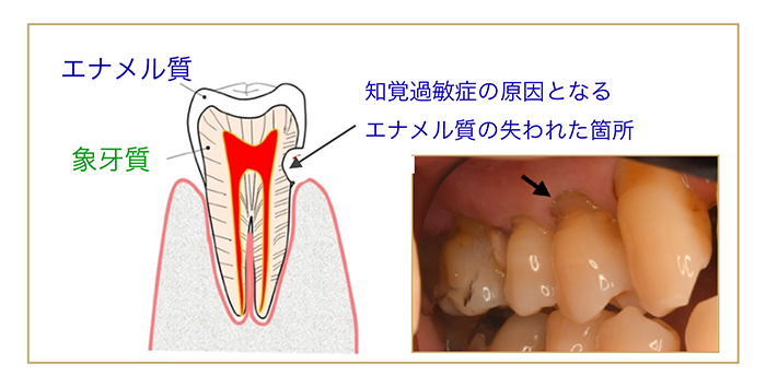 知覚過敏症から歯を守る