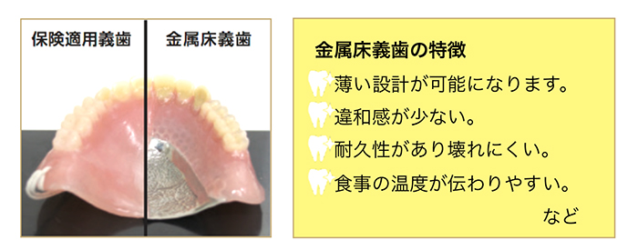 快適な金属床義歯