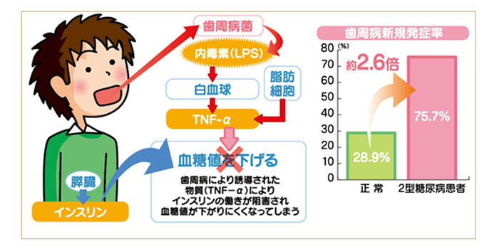 口腔ケアと糖尿病