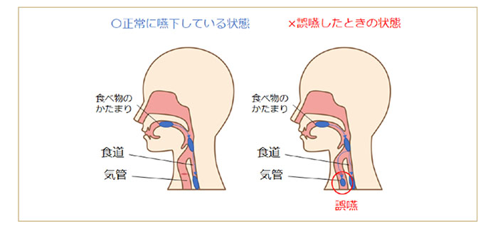 口腔ケアと誤嚥性肺炎