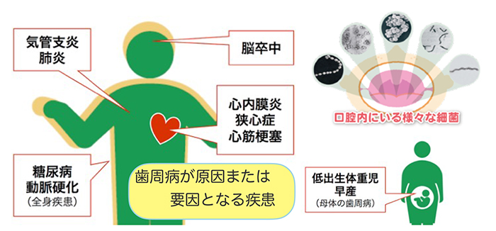 口腔健康と全身健康を守るための口腔衛生