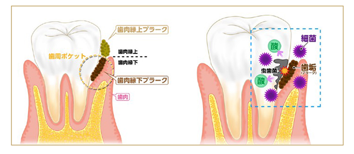 むし歯・歯周病の原因プラーク