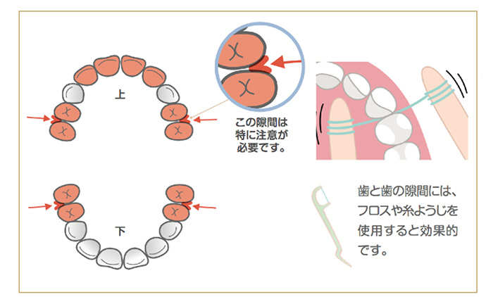 お子様の歯を守る仕上げ磨き