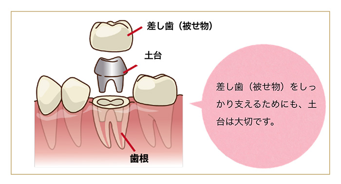 差し歯（被せ物）を支える大切な土台