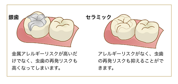 先進国での銀歯