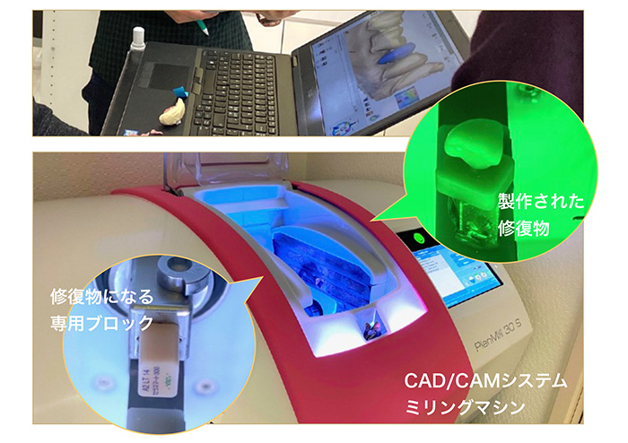 CAD/CAMシステムによる高精度なむし歯治療