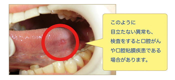 口腔がんや口腔粘膜疾患を見逃さないために