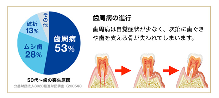 知らぬ間に進行する歯周病