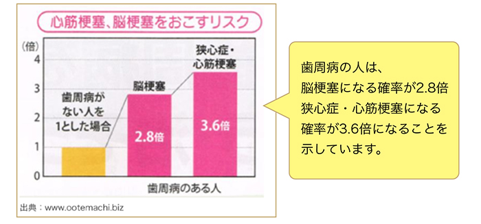 シリーズ②歯周病と全身疾患 ～脳血管疾患～