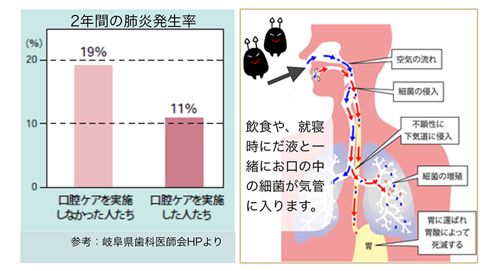 シリーズ④歯周病と全身疾患 ～誤嚥性肺炎～