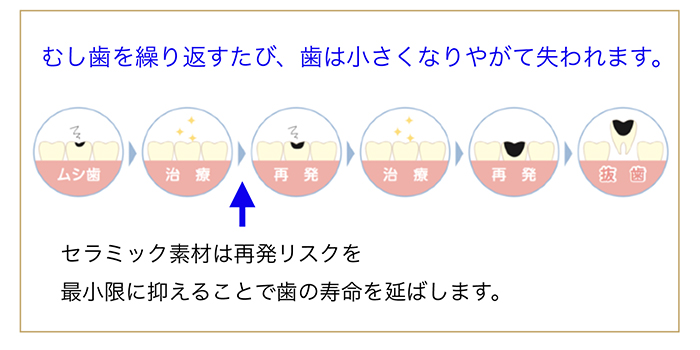 再発リスクを抑えるむし歯治療