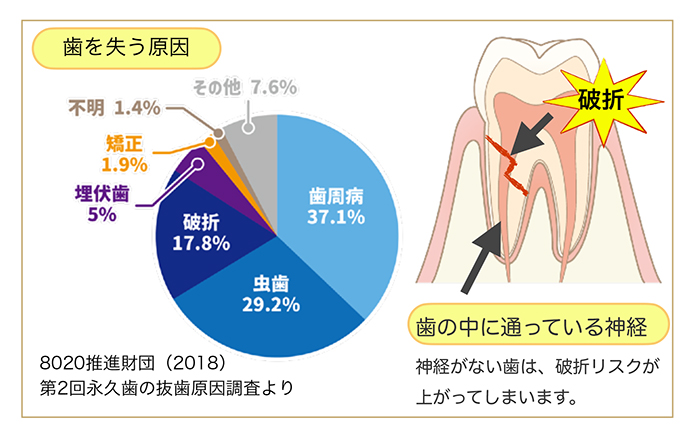 治療ができず抜歯になる歯根破折①