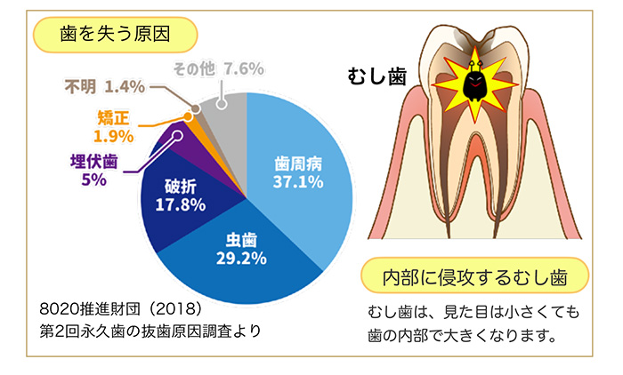 むし歯の大きさと歯の寿命