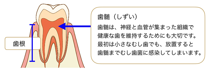 歯の内部の治療「根管治療」