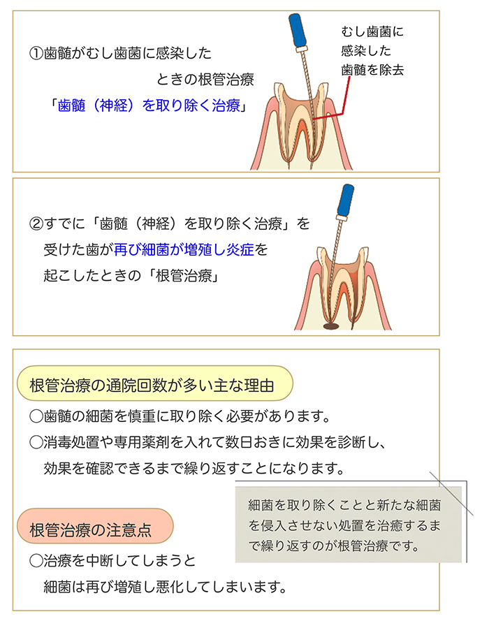 なぜ？根管治療は通院回数が多いの？