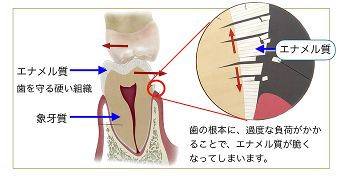 一瞬の不快を与える知覚過敏症