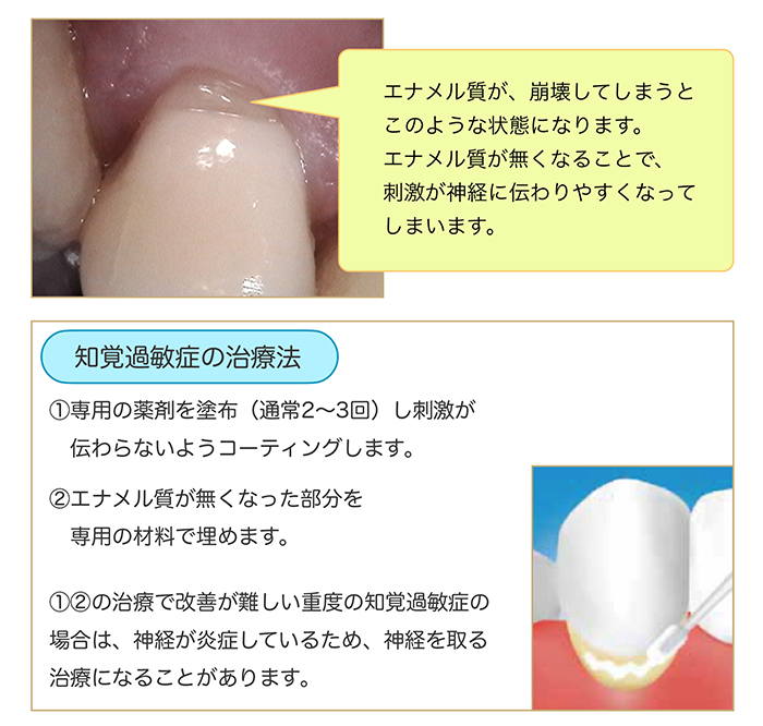 知覚過敏症の治療と予防