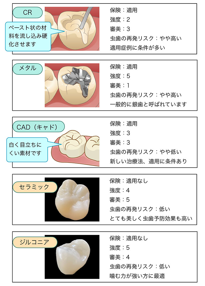 詰め物の種類と特徴