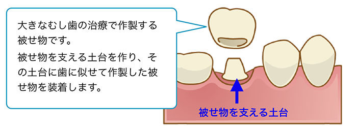 大きなむし歯治療の被せ物